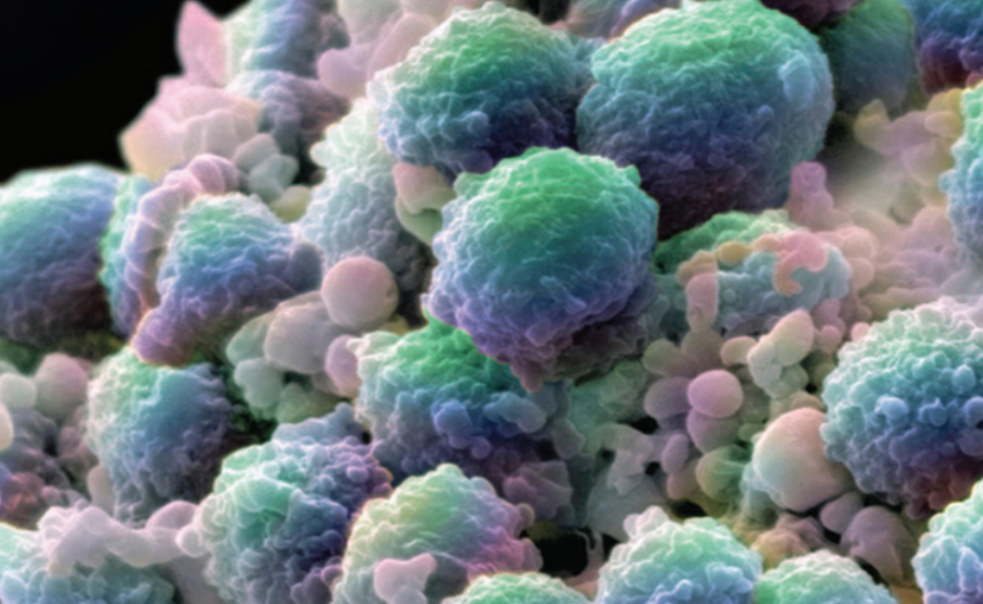 The Prostate Cancer Photodynamic Therapy (PDT) Study